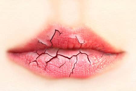губы с трещинами